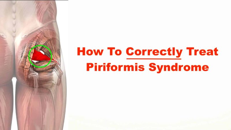 Understanding Piriformis Syndrome: Causes, Symptoms, Diagnosis, and Treatment